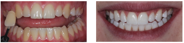 tooth whitening before and after